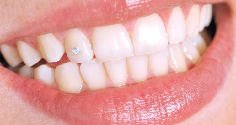 smile-with-tooth-gem-752x400.webp